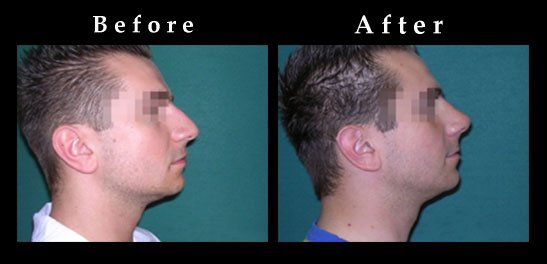 Nose Surgery – Rhinoplasty Photos – Ref. #2429
