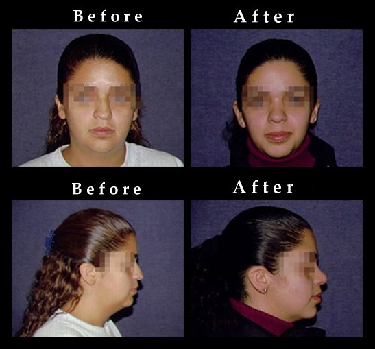 Nose Surgery – Rhinoplasty Photos – #2426