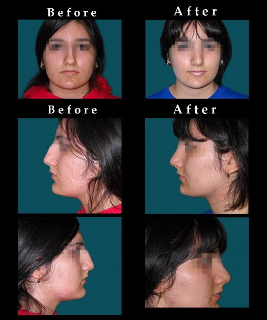 Nose Surgery – Rhinoplasty Photos – #2424