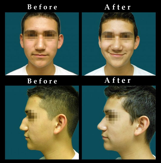 Nose Surgery – Rhinoplasty Photos #2423