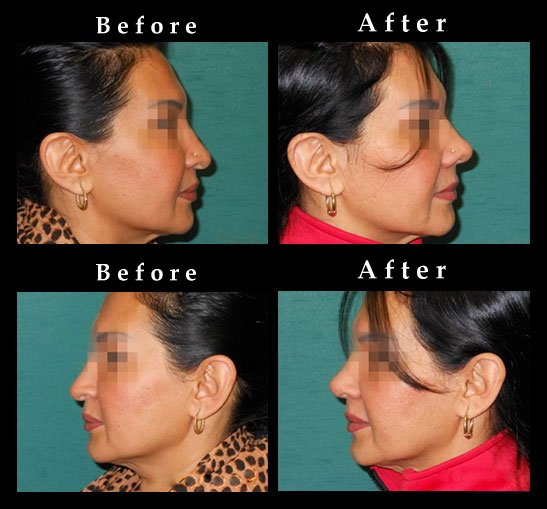 Nose Surgery – Rhinoplasty Photos – #2540