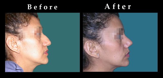 Nose Surgery – Rhinoplasty Photos – Ref. #2422