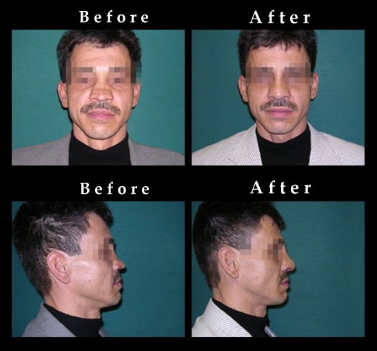 Nose Surgery – Rhinoplasty Photos – #2432