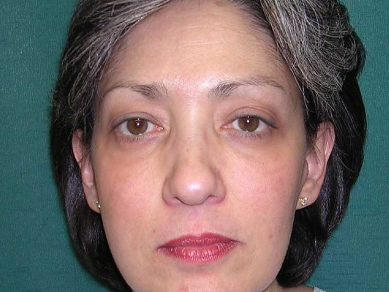 eyelid surgery after