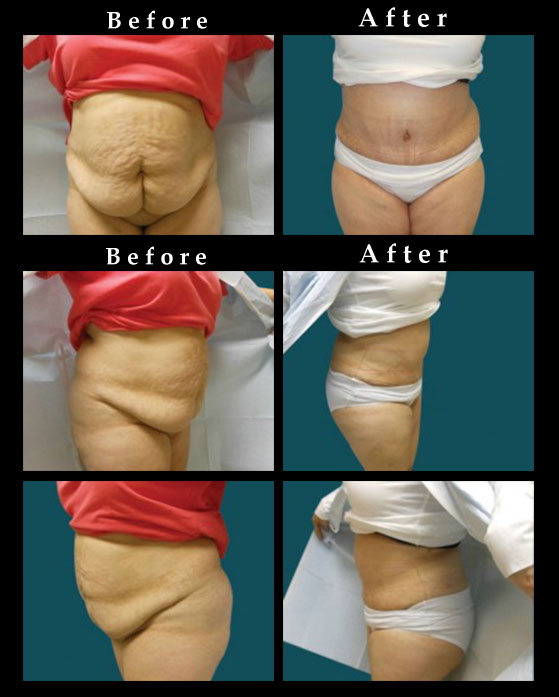 Tummy Tuck – Extended Abdominoplasty | Before and After Photos