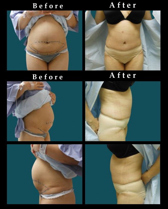 Tummy Tuck Chicago Before and After
