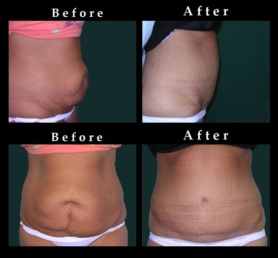 Tummy Tuck Pictures Chicago