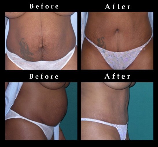 Abdominoplasty Surgery Pictures