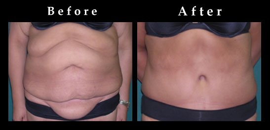 Extended Abdominoplasty Pictures | Tummy Tuck