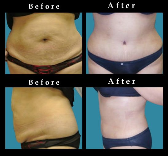 Standard Tummy Tuck – Abdominoplasty Before and After Chicago