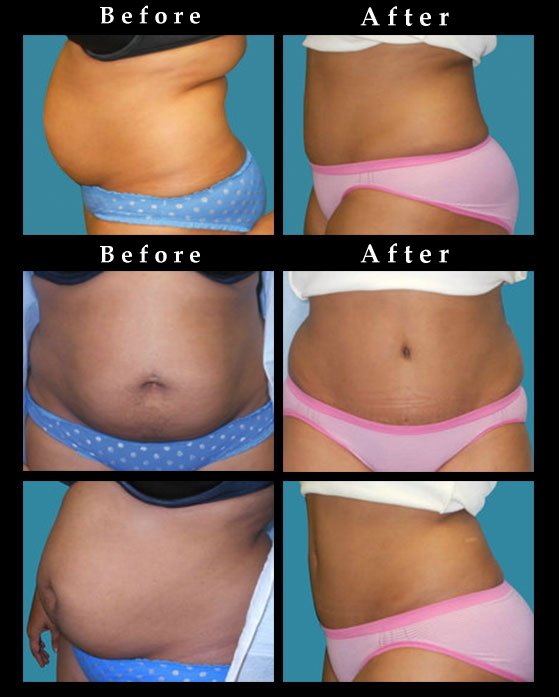 Natural Belly Button after Tummy Tuck | Abdominoplasty Chicago